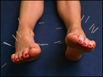 Health: Acupuncture in the UK 健康：針灸在英國