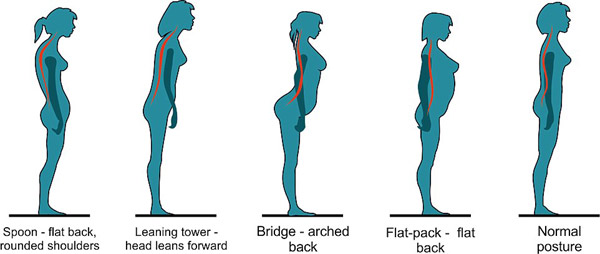 你是“勺形”還是“橋形”？站姿決定背痛與否